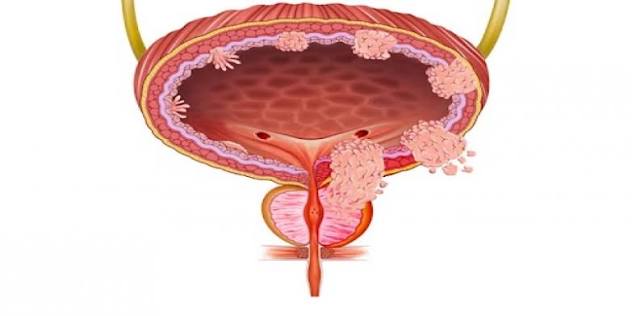 Holmium laser enucleation of the prostate HoLEP